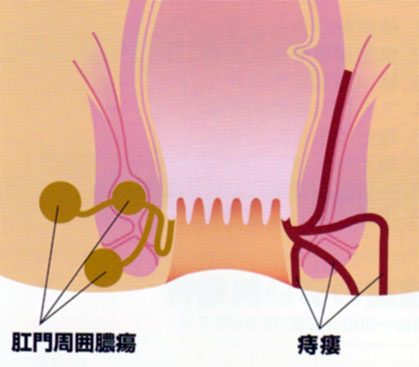 お 尻 の 穴 でき もの