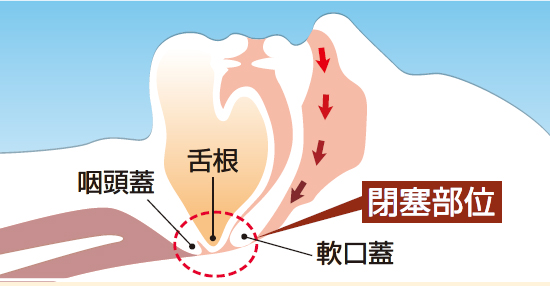 日中の眠気 いびきは睡眠時無呼吸症候群 異常が起こる前に検査をしよう 江東区 東大島駅 の苦痛のない胃 大腸カメラ 日帰りポリープ切除 肛門科手術