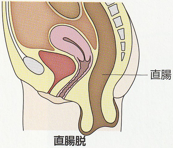 おしりから腸が出てきてしまう 実は意外な原因が 江東区 東大島駅 の苦痛のない胃 大腸カメラ 日帰りポリープ切除 肛門科手術